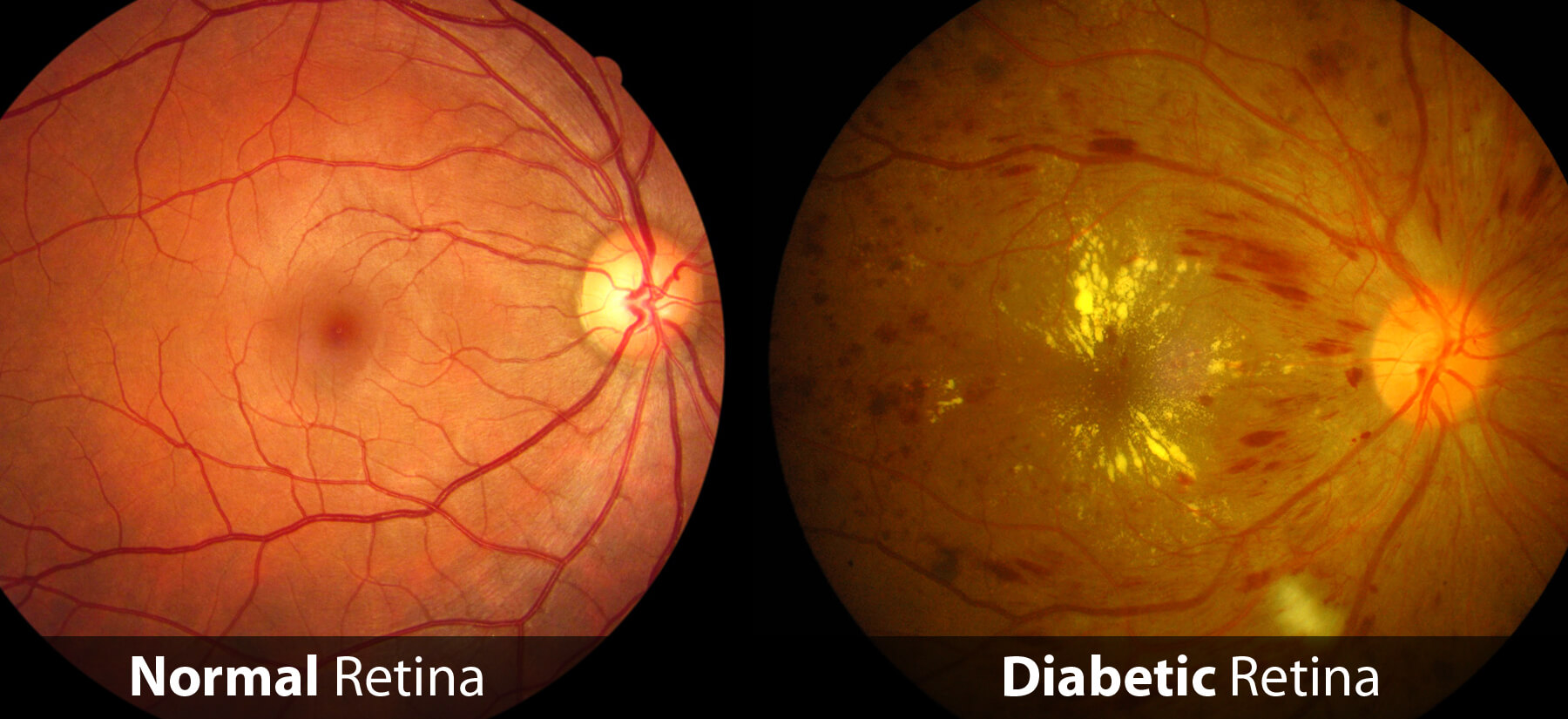 Diabetic retinopathy ophthalmology